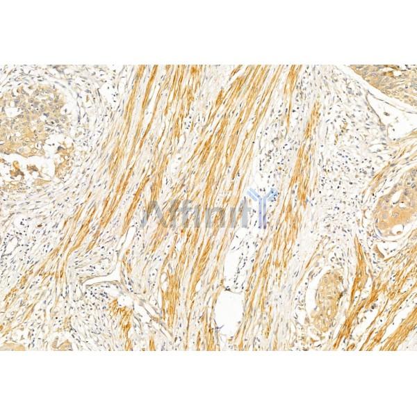 AF7001 Collagen I Antibody IHC Human esophageal cancer